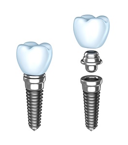 Dental Implants | Dentist In Katonah, NY | ParkLin Dental